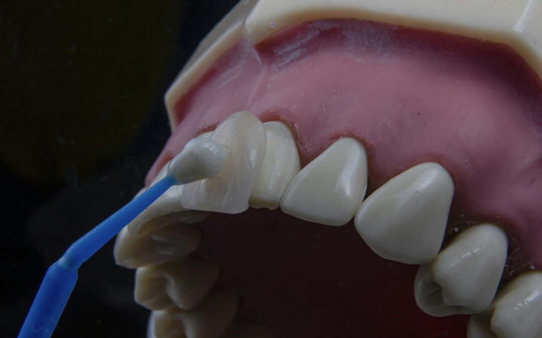 Transform Your Smile with a Skilled Veneers Dentist Today