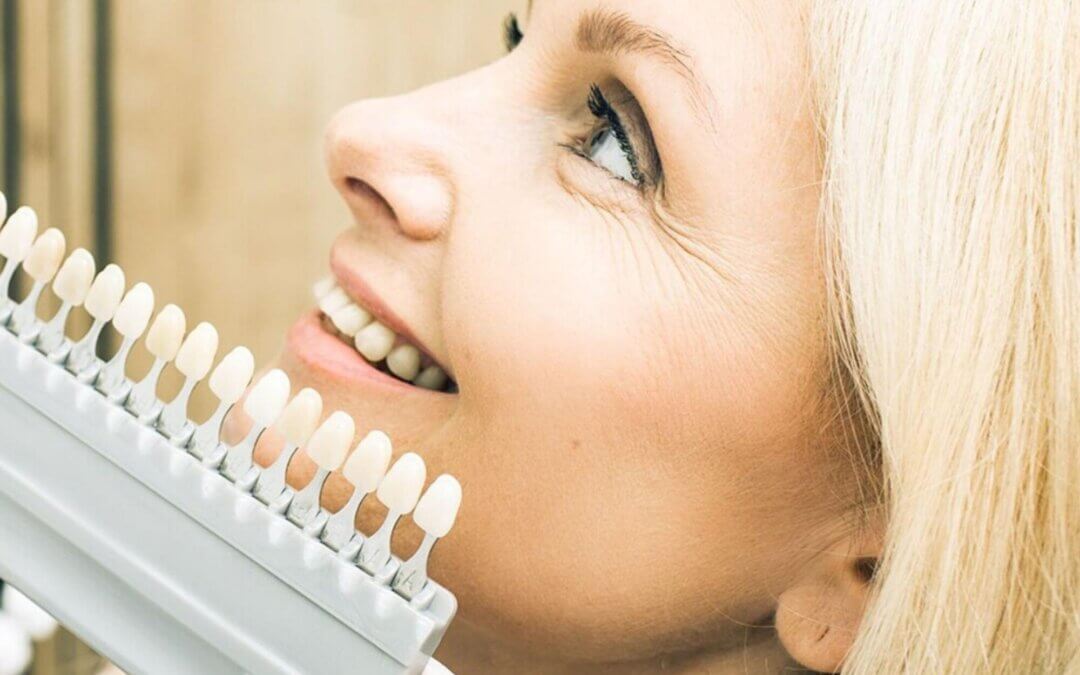 Achieve a Stunning Smile with Veneers Today